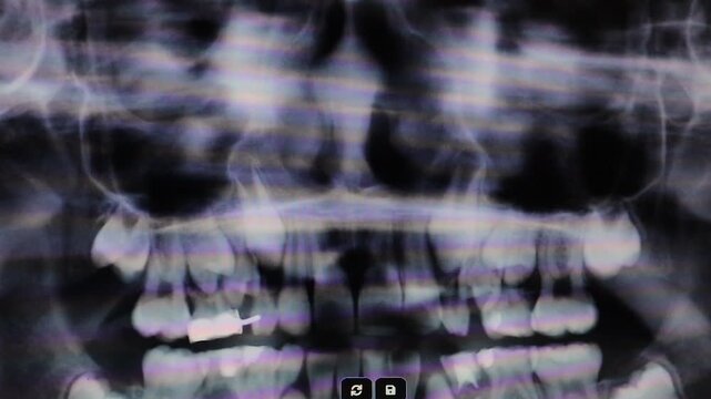 Dentist reviewing panoramic dental X-ray of a 9-year-old child, showing pediatric dental space maintainer planning, primary and permanent teeth development, hidden wisdom tooth in the jaw. Dentistry.
