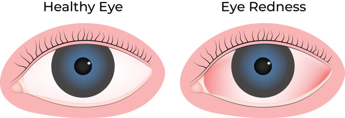 Healthy Eye vs Red Eye A Visual Comparison of Ocular Conditions