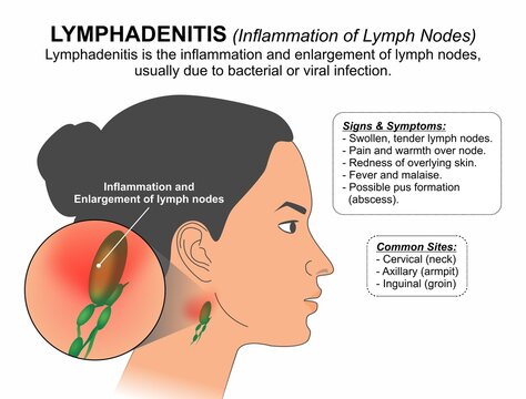 Lymphadenitis (Inflammation of Lymph Nodes)