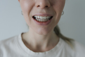 Close-up of a smiling woman wearing transparent dental aligners. Concept of modern dentistry,...