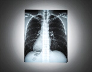 x ray of a chest