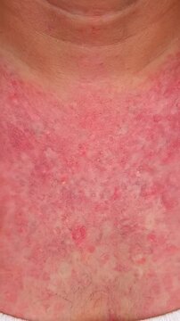 Skin treatment visible on patient chest. Redness demonstrates condition healing process. Professional atmosphere enhances care and comfort. Vertical orientation captures details.