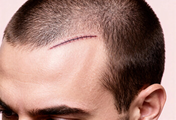 Obraz premium Healing process of surgical scar on head after hair transplant