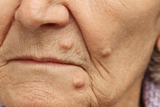 Closeup of Elderly Woman's Face Featuring Dermal Fibroma and Subtle Wrinkles