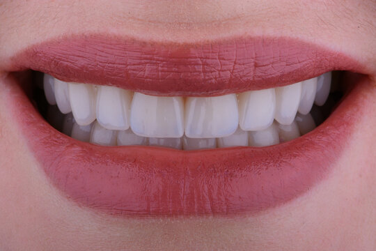 Female smile makeover by dental ceramic veneer, porcelain laminate veneers.