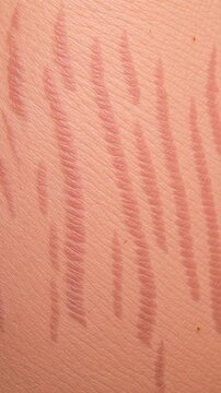 Skin texture stretch mark scar anatomy medical detail narrow groove line pattern organic surface human body closeup healthcare concept dermatology epidermis natural body surface pink line pattern