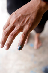 Fototapeta premium Injured Finger with Dried Blood from Pinched Accident