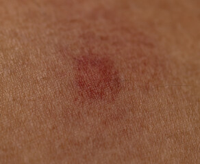 A red mark on a person's arm