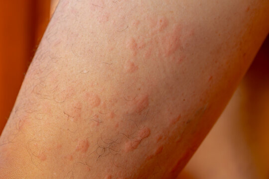 Healthcare and medical concept, Selective focus of left hand side leg with exanthematous on thigh and knee, A man show his leg with eruption or skin rash and itchy from allergy, Skincare background.