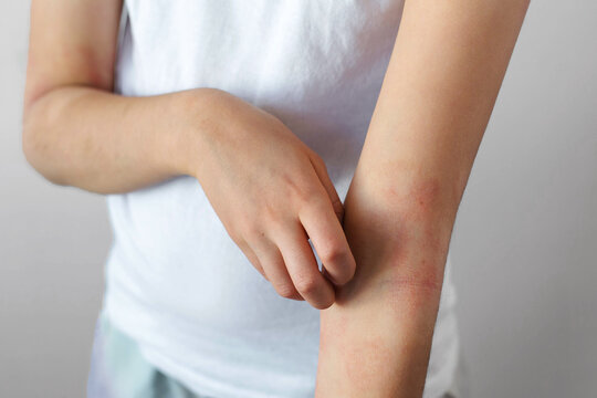 Child scratching inflamed dry skin on arm showing atopic dermatitis eczema symptoms, allergic skin disease concept, itching irritation redness, pediatric dermatology healthcare awareness