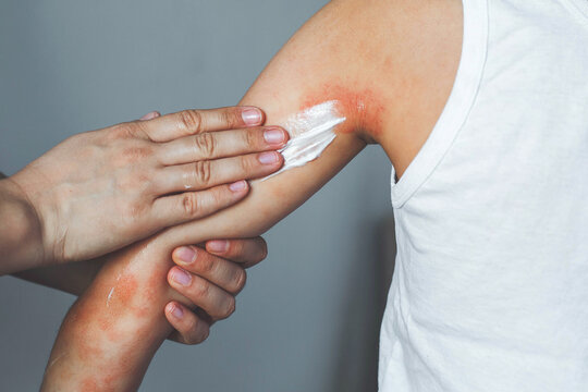 Parent applying soothing cream to child inflamed skin on arm showing severe atopic dermatitis eczema flare, medical skincare treatment, pediatric dermatology care, allergy relief and healing concept