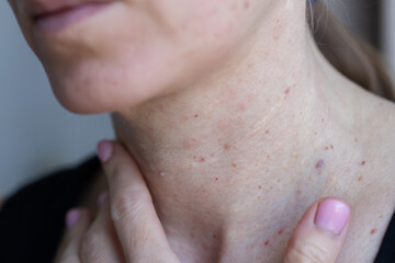 Female neck after beauty injections. Biorevitalization concept.