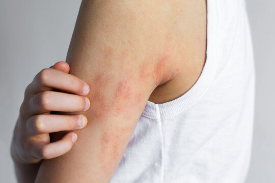 Child scratching irritated elbow with visible atopic dermatitis eczema symptoms, dry red patches on sensitive skin, chronic allergy condition, pediatric dermatology problem, itching discomfort concept