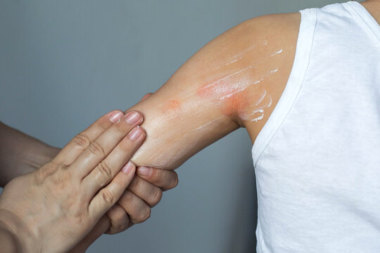 Child upper arm with visible eczema flare while parent applies moisturizing cream, red irritated skin inflamed patches showing atopic dermatitis care, pediatric skincare treatment, healthcare concept