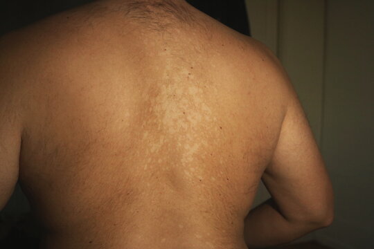 Tinea Versicolor on the Back with Hypopigmented Skin Patche