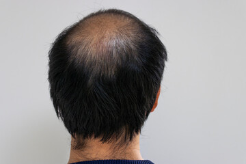 薄毛の男性の頭（日本人、30代）