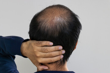 薄毛の男性の後頭部と手（日本人、30代）
