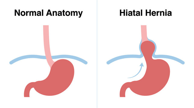 Medical Illustration Comparing Normal Anatomy and Hiatal Hernia with Stomach Protruding through the Diaphragm for Healthcare Education