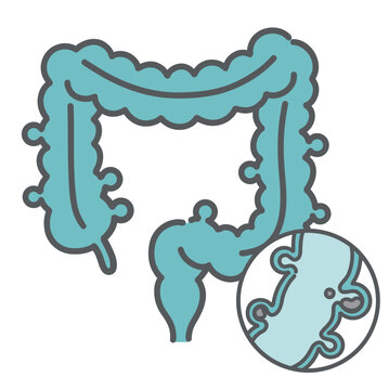 大腸憩室症の全体像と内部構造（便の詰まり）の図解イラスト