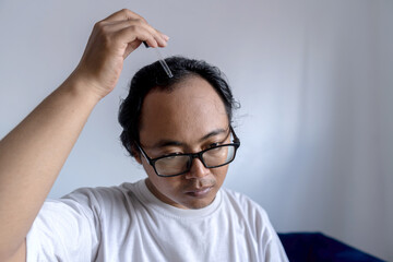 A man drops serum using a pipette onto his scalp in the bald area, hair loss treatment, Concept of baldness treatment or hair restoration