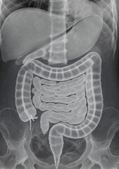 X-ray image of human digestive system