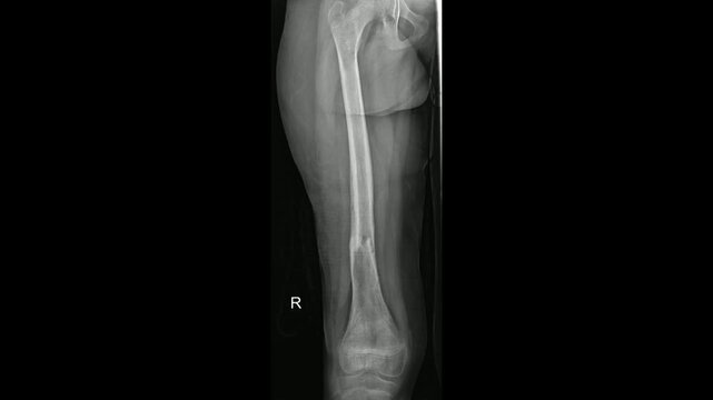 xray of femur fracture ap view 