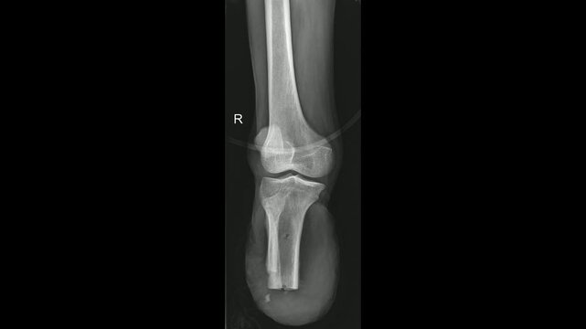 Amputated Right  lower  leg X-ray
