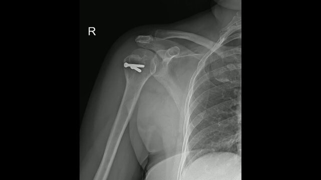 Post-operative X-ray of Right Shoulder with Humeral Head Screw Fixation