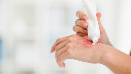 Close-up skincare treatment ointment being applied on arm with soft clinical light, hygiene focus