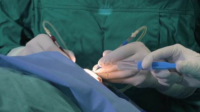 Extreme close-up of an ophthalmologist surgeon's hands, phacoemulsification procedure during cataract eye surgery