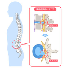 腰椎椎間板ヘルニア　椎間板の構造　腰痛