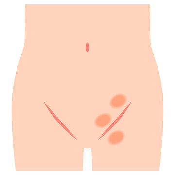 鼠径ヘルニアの種類　ヘルニア　股関節