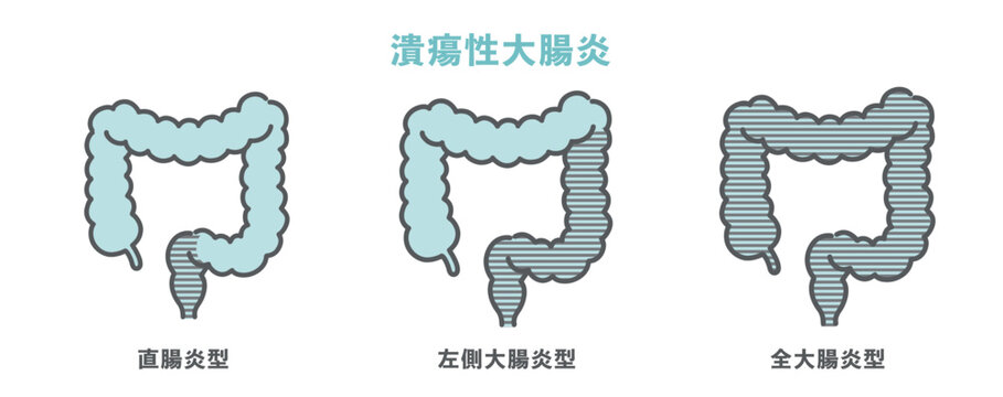 潰瘍性大腸炎の病変範囲分類（直腸炎型・左側大腸炎型・全大腸炎型）