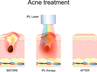IPL therapy. Acne treatment. Skin before and after Intense pulsed light procedure