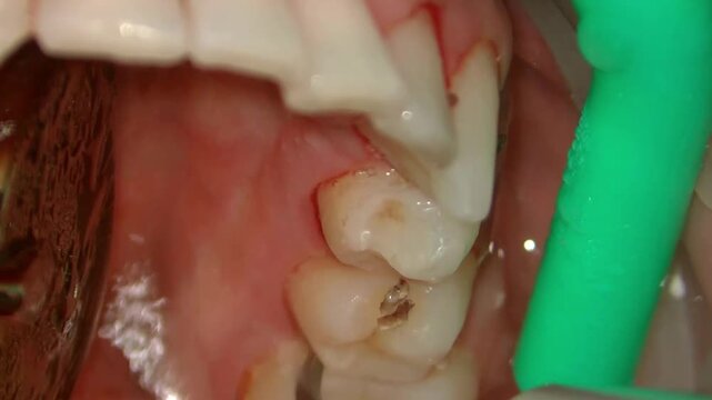 tooth tartar and calculus cleaning