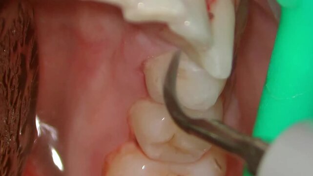 tooth tartar and calculus cleaning