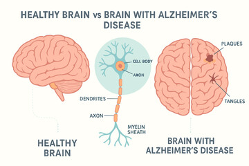 Healthy brain vs brain with alzheimer's disease: key differences illustrated