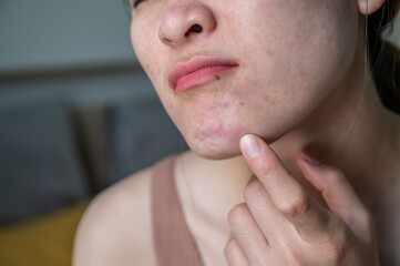 Cropped shot view of Asian woman having pain because of acne occur on her chin. The deeper and larger the pimple, the more painful it can be.
