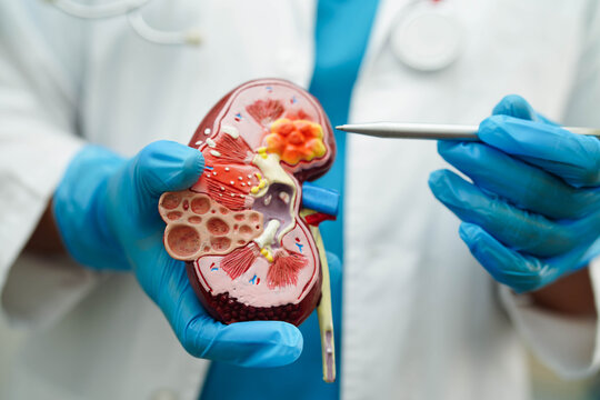 Chronic kidney disease, Asian woman with model for treatment urinary system, urology, Estimated glomerular filtration rate eGFR.