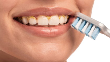 Partial smile featuring teeth with noticeable plaque along the gums paired with a toothbrush beside highlighting plaque removal importance in dental care.