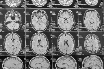 Magnetic resonance imaging or MRI image of the brain