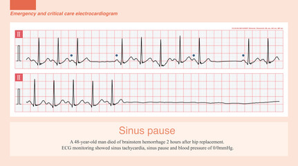 Although the diagnostic criteria of sinus pause defined by ESC and AHA are greater than or equal to 2S and 3S, respectively, some exceptions sometimes occur.
