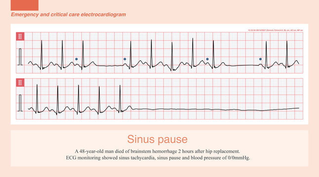 Although the diagnostic criteria of sinus pause defined by ESC and AHA are greater than or equal to 2S and 3S, respectively, some exceptions sometimes occur.
