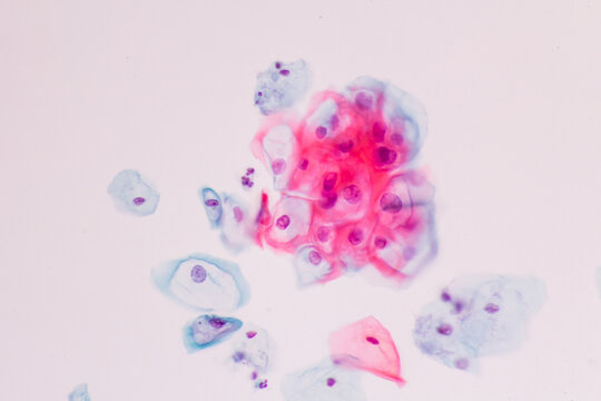 Abnormal human squamous epithelial cells view in microscopy.HPV criteria for pap smear slide cytology and pathology.Koilocyte cells on white background.Woman cervical cancer cell medical concept.