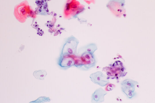 Abnormal human squamous epithelial cells view in microscopy.HPV criteria for pap smear slide cytology and pathology.Koilocyte cells on white background.Woman cervical cancer cell medical concept.