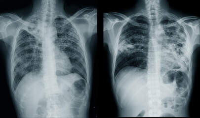 X-ray images of pneumonia and lobar pneumonia  in blue tone 