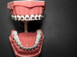 Dental model showcasing braces on upper and lower teeth against a dark background. Ideal for educational purposes, promoting orthodontic practices, or dental demonstrations. © daily_creativity
