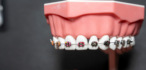 Detailed view of a dental model showcasing orthodontic braces on a row of artificial teeth. The...