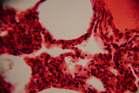Histological image showing bone marrow tissue with dense clusters of reddish-stained hematopoietic cells and visible white fat areas at high magnification.