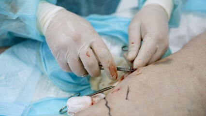 Surgeon hands performing medical procedure on patient leg